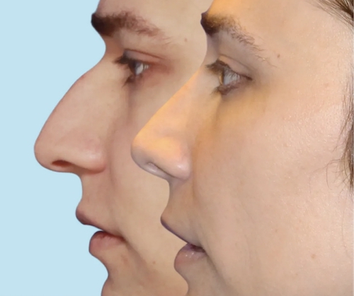 ترند قوز بینی