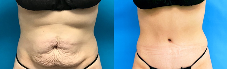 مزایای جراحی لیفت شکم