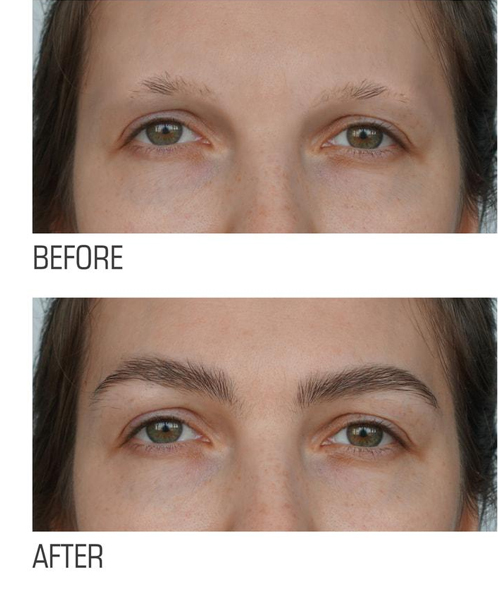 روش‌های کاشت ابرو اقساطی در کلینیک لیلیوم سفید