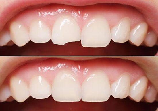 کامپوزیت برای طرح لبخند، مناسب دندان های شکسته