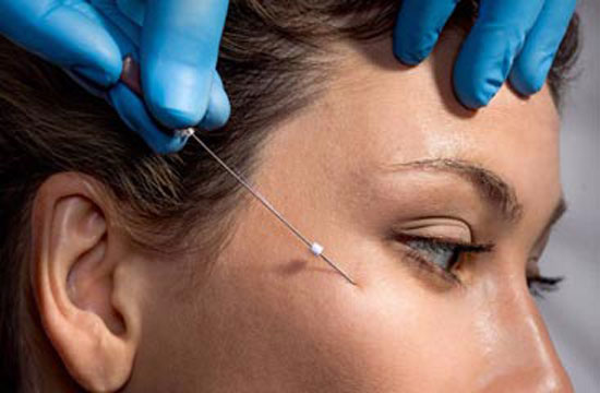 کاربرد و مزایای لیفت صورت با نخ