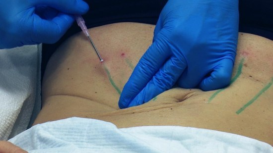 چگونگی انجام جراحی لیفت شکم