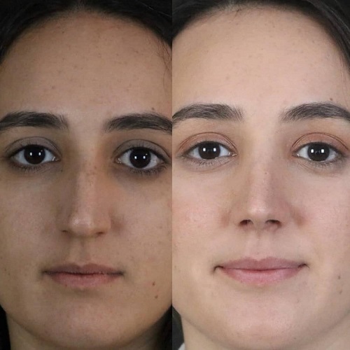 دلایل انجام جراحی بینی ترمیمی