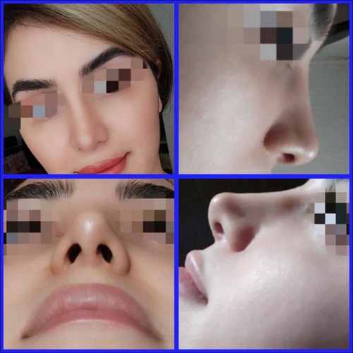 بهترین جراح بینی ترمیمی در تهران کیست؟