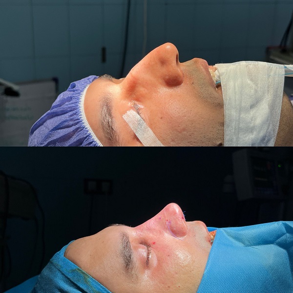 نمونه جراحی بینی طبیعی مردان