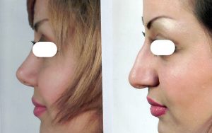 بینی نیمه فانتزی استخوانی