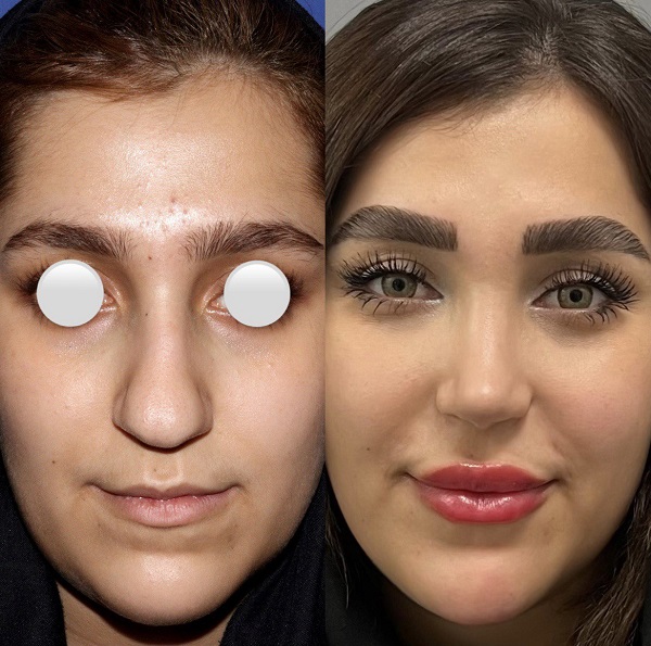 ویژگی های بهترین جراح بینی طبیعی