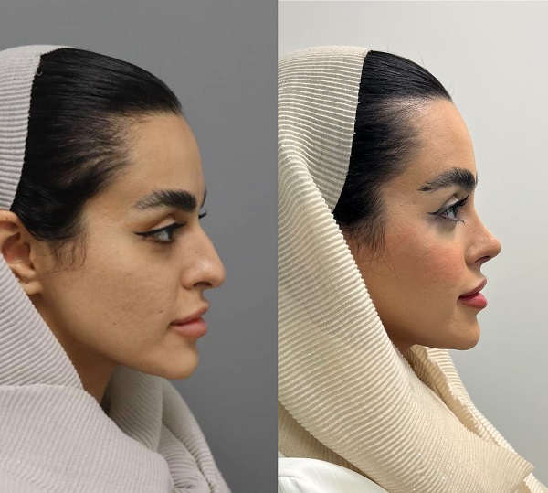 بهترین جراح بینی طبیعی در تهران +معرفی 10 جراحی برتر و نمونه کار