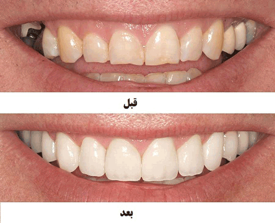 طرح لبخند با کامپوزیت، مناسب دندان های فاصله دار