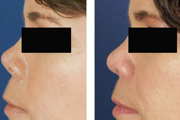 انواع روش ترمیم بینی سربالا