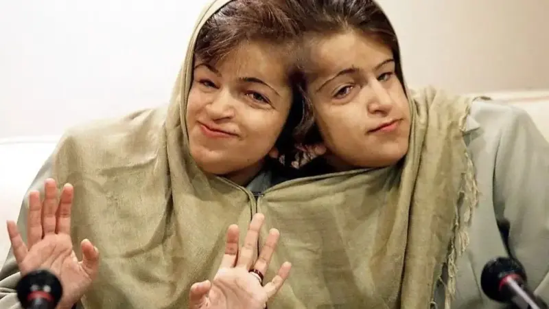 بیوگرافی لاله و لادن دوقلوهای به هم چسبیده دهه 60 ای 