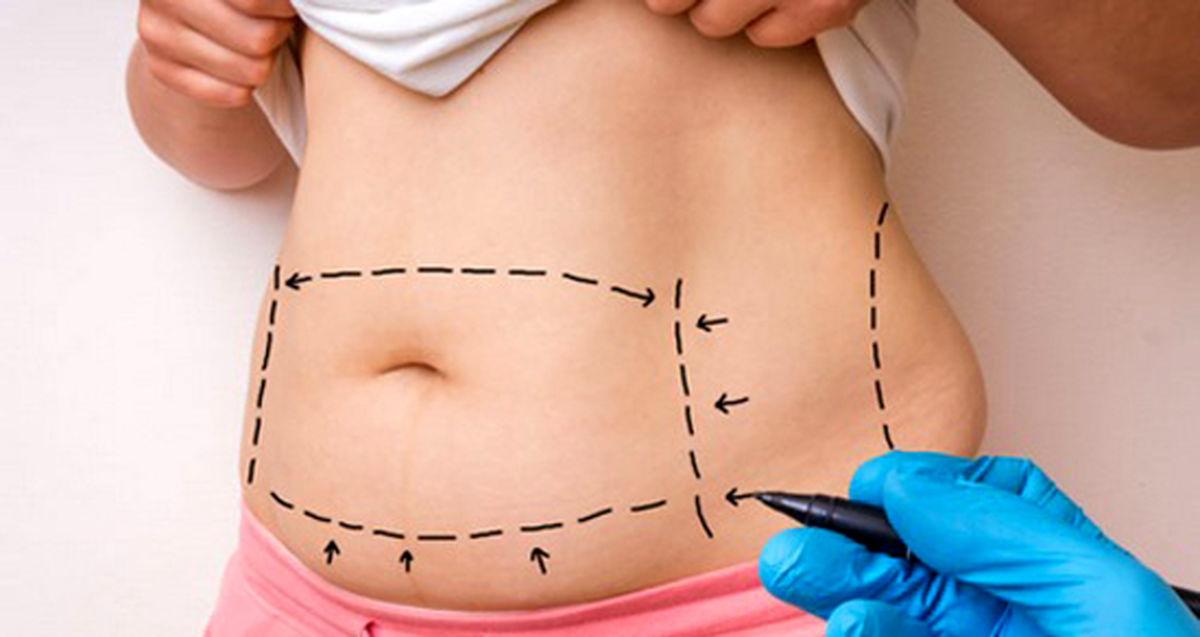 لیفت شکم و پهلو؛ راهکاری جراحی و بدون جراحی برای تغییر شگفت‌انگیز بدن شما