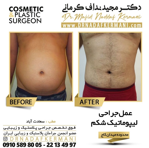 جراحی لیفت شکم و پهلو چیست؟