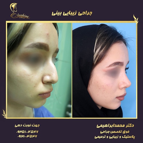 زمان مناسب برای ترمیم بینی خوکی بعد از عمل