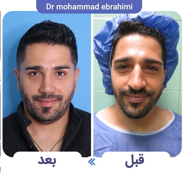 علت اصلی خوکی شدن بینی بعد از عمل