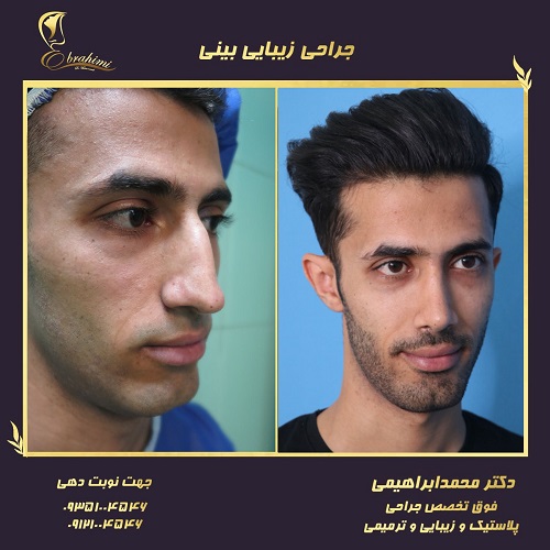 مراقبت های بعد از ترمیم بینی عملی خوکی