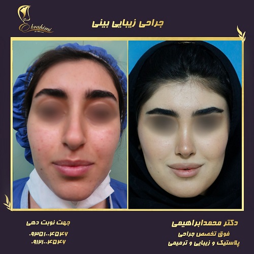 عمل جراحی بینی سربالا + ترمیم بینی خوکی