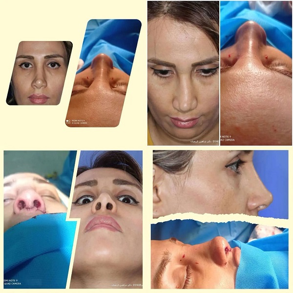 جراحی بینی ترمیمی چیست؟