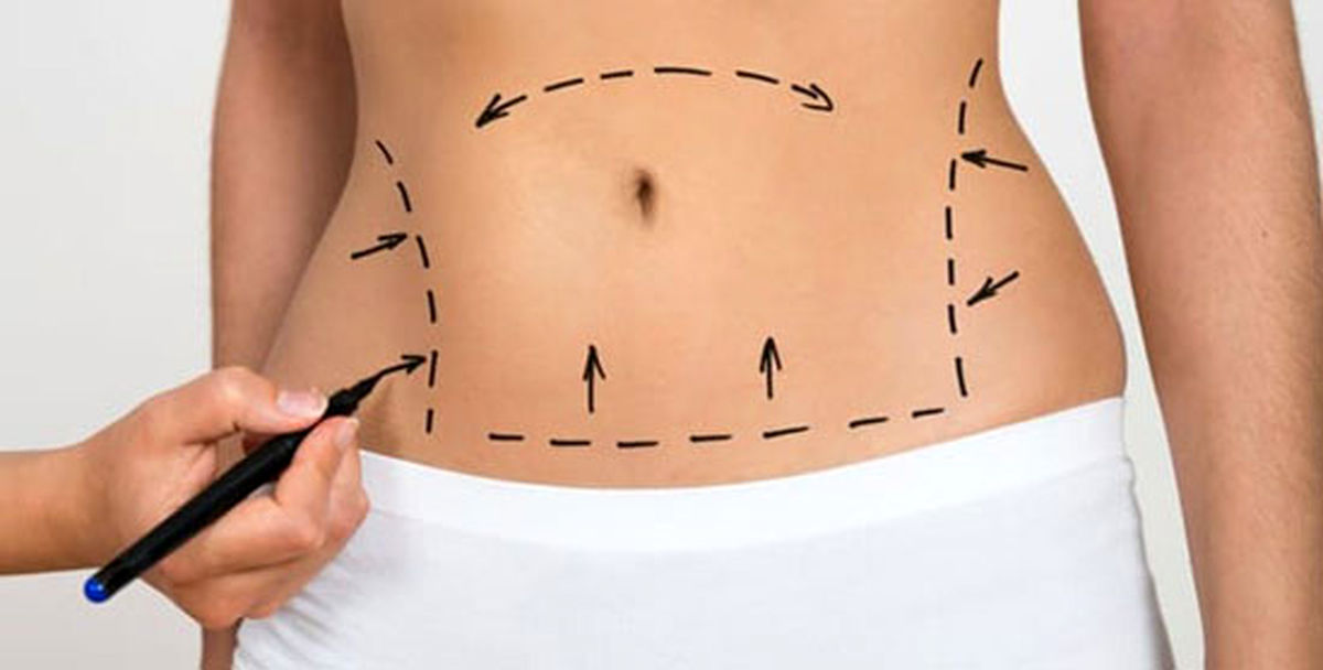 هزینه جراحی زیبایی شکم در ۱۴۰۴؛ چقدر برای اندام رویایی باید پرداخت کرد؟