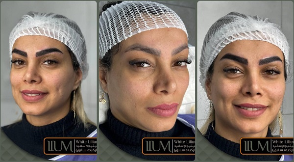 مراحل کاشت ابرو اقساطی