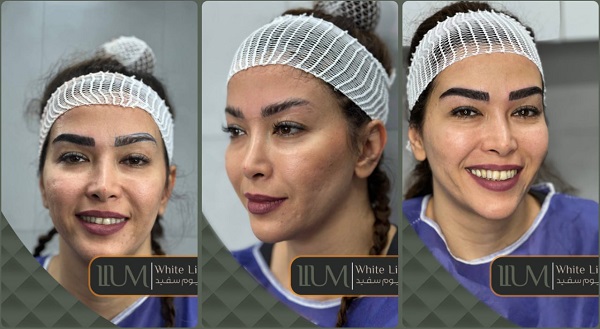 مزایای کاشت ابرو قسطی در کلینیک زیبایی لیلیوم سفید