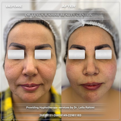 هایفو یا لیفت صورت با نخ؟ کدام روش بهتر است؟