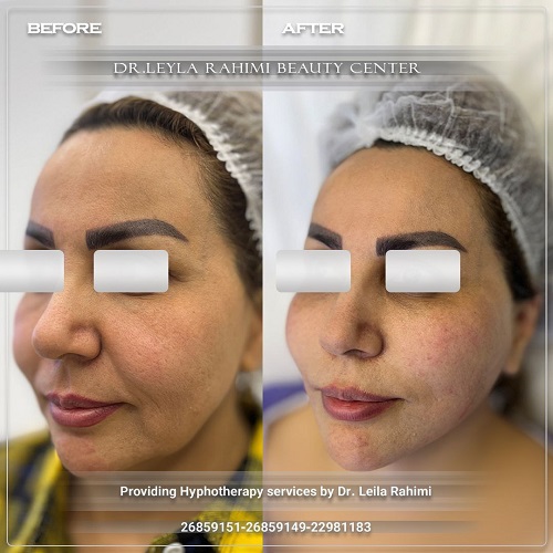 برای جوانسازی پوست هایفوتراپی بهتر است یا لیفت صورت؟