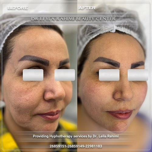 لیفت با نخ و هایفو چه تفاوتی دارند؟