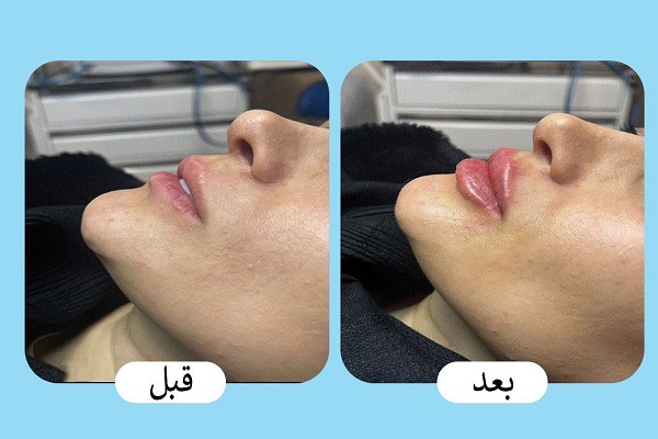 قیمت تزریق انواع ژل لب (فیلر) در سال 1404