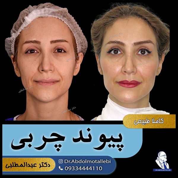 بهترین دکتر تزریق چربی در تهران چه ویژگیهایی دارد؟