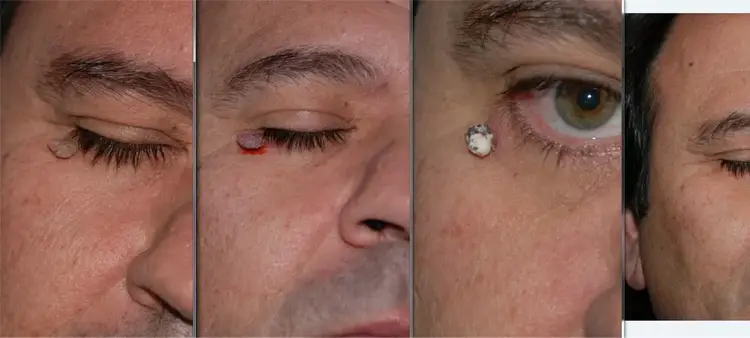 مراقبت های پس از فریز کردن خال گوشتی