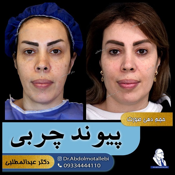 نحوه کار بهترین دکتر تزریق چربی در تهران