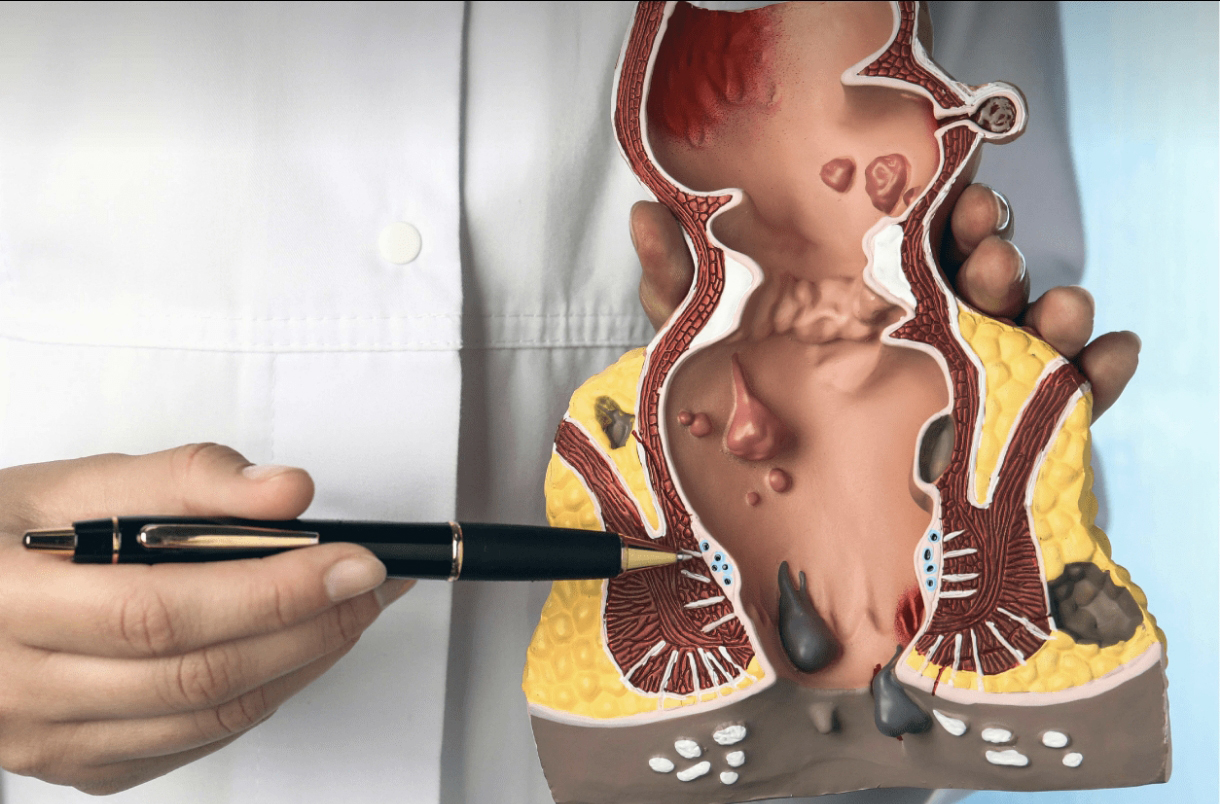 درمان فوری بواسیر