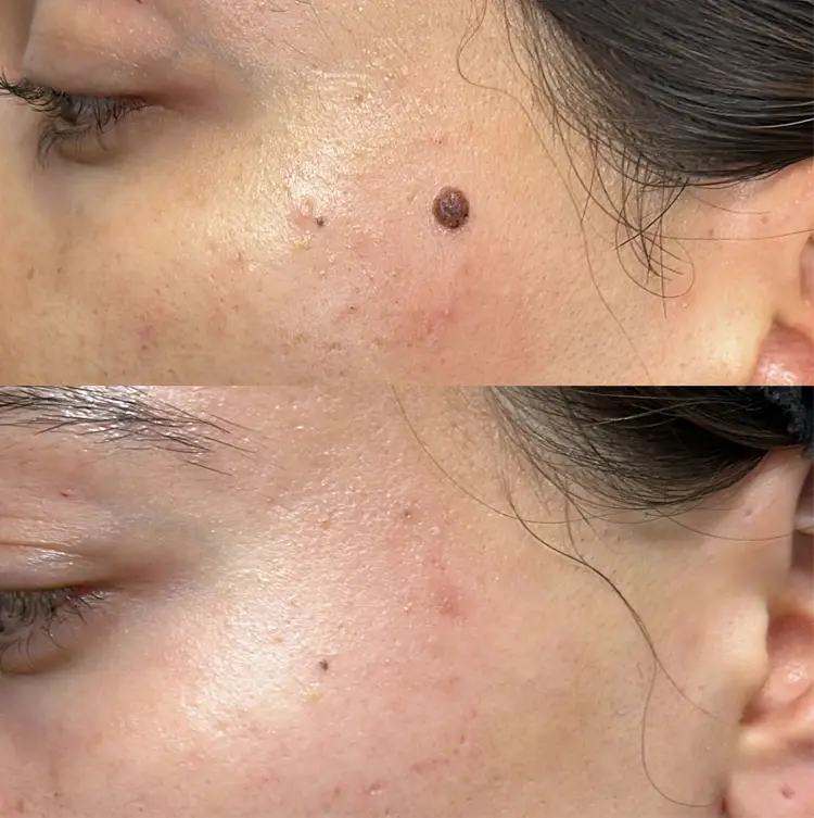 انواع خال گوشتی