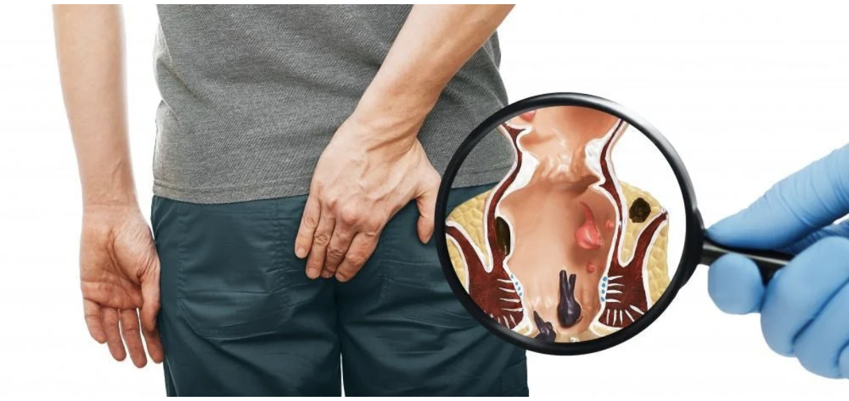 درمان فوری بواسیر، شقاق و فیستول بدون بیهوشی؛ روش‌های نوین ۱۴۰۴ 