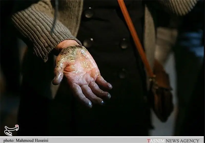 آمار تکان‌دهنده سوختگی در ایران؛ 300 هزار قربانی سالانه بدون تخت استاندارد دولتی!