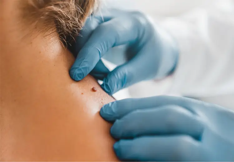 فریز کردن خال گوشتی چیست و چگونه انجام می شود؟