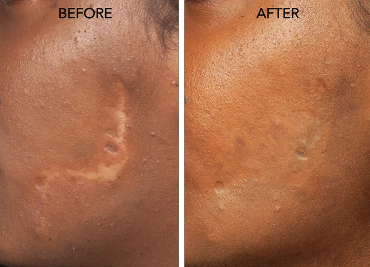 مزایای درمان جای زخم با سلول های بنیادی چیست؟