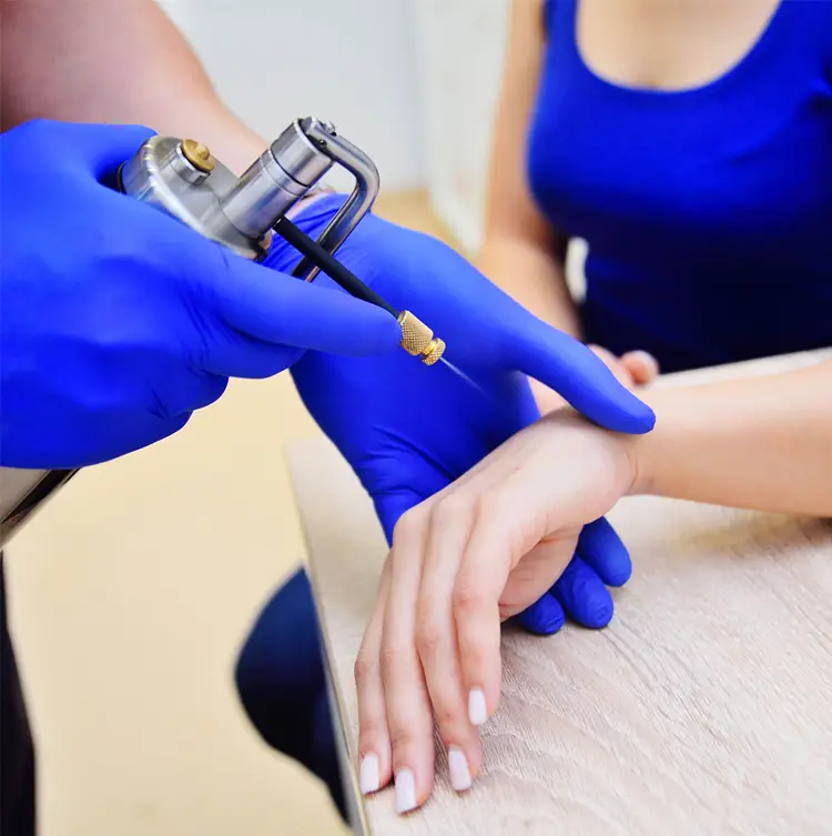 کرایوتراپی یا فریز کردن خال گوشتی