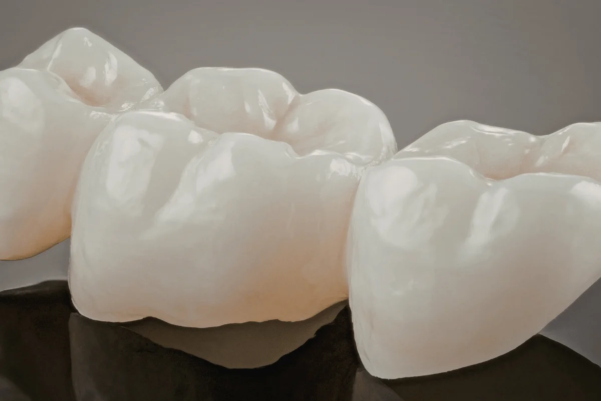 ایمپلنت دندان