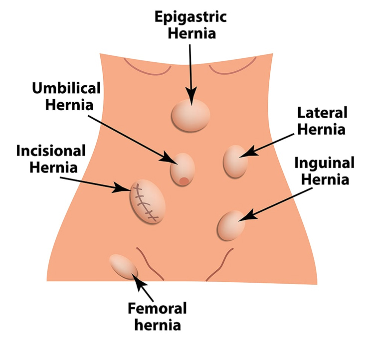 آیا درمان فتق بدون بیهوشی 