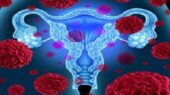فیبروم رحمی با خطر بیماری قلبی در زنان مرتبط است