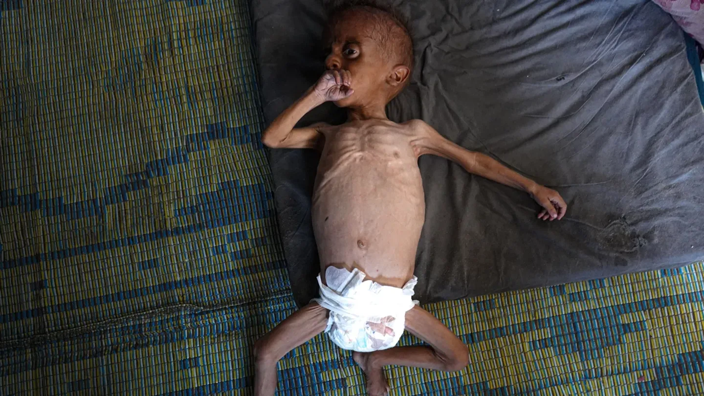 لاغری ناشی از سوءتغذیه کودک فلسطینی در غزه