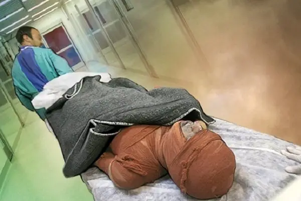 از کمبود تخت تا هزینه‌های سنگین درمان؛ روایت سوختگی در ایران