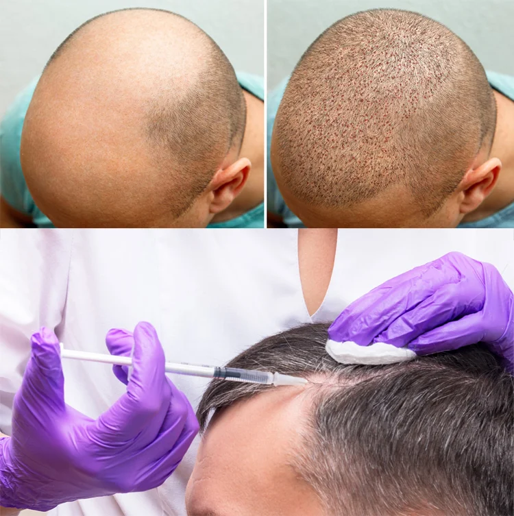 روش انجام پی آر پی بعد از کاشت مو