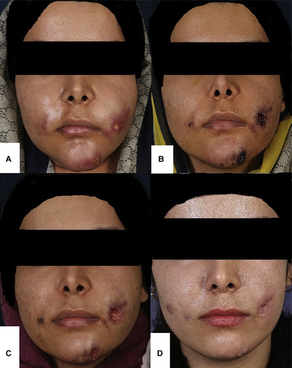 انواع عفونت