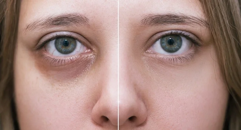 درمان سریع گودی زیر چشم با PRF