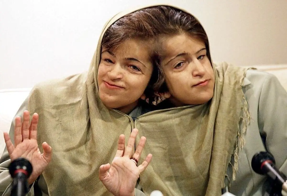 تصویری نایاب از کودکی لاله و لادن؛ دوقلوهای به هم چسبیده دهه 50 که قلب‌ها را لرزاندند