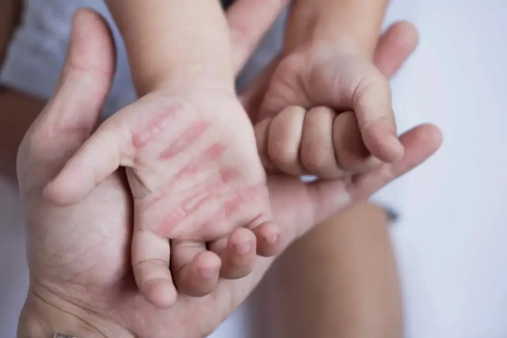 از کمبود تخت تا هزینه‌های سنگین درمان؛ روایت سوختگی در ایران