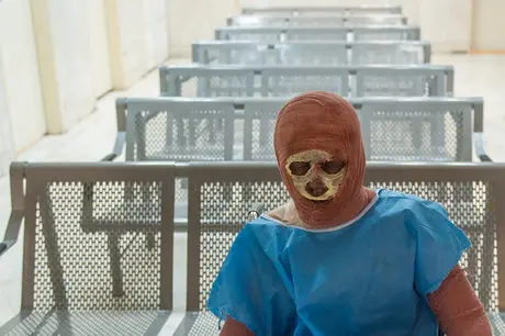 پوشش بیمه‌ای پانسمان‌های نوین سوختگی؛ پایان کابوس هزینه‌های سرسام‌آور درمان!